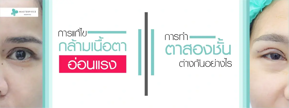 การแก้ไขกล้ามเนื้อตาอ่อนแรงกับการทำตาสองชั้น ต่างกันอย่างไร