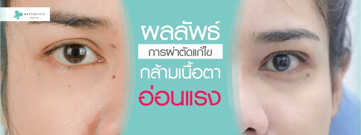 ผลลัพธ์การผ่าตัดแก้ไขกล้ามเนื้อตาอ่อนแรง
