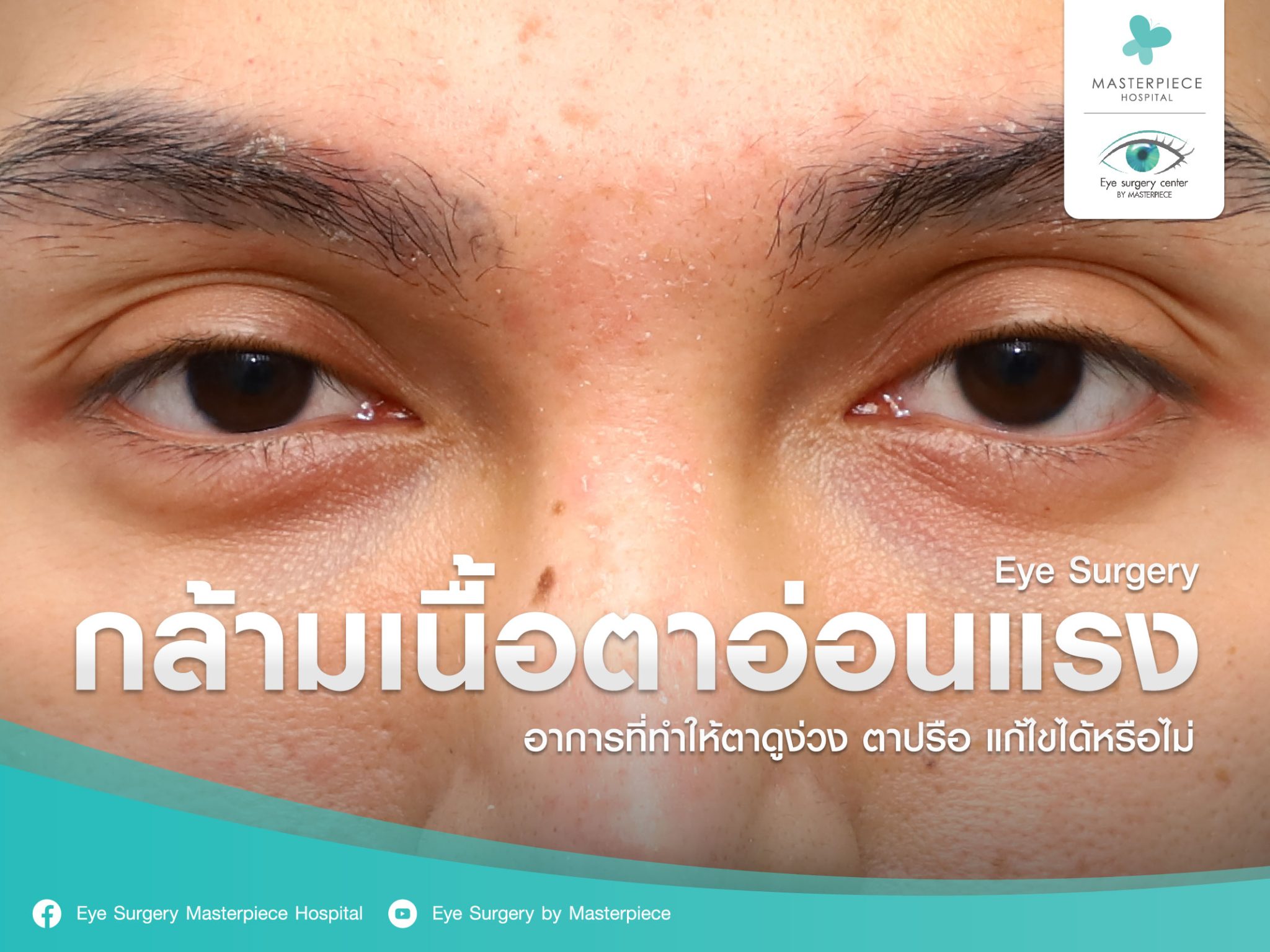 กล้ามเนื้อตาอ่อนแรง อาการที่ทำให้ตาดูง่วง ตาปรือ แก้ไขได้หรือไม่