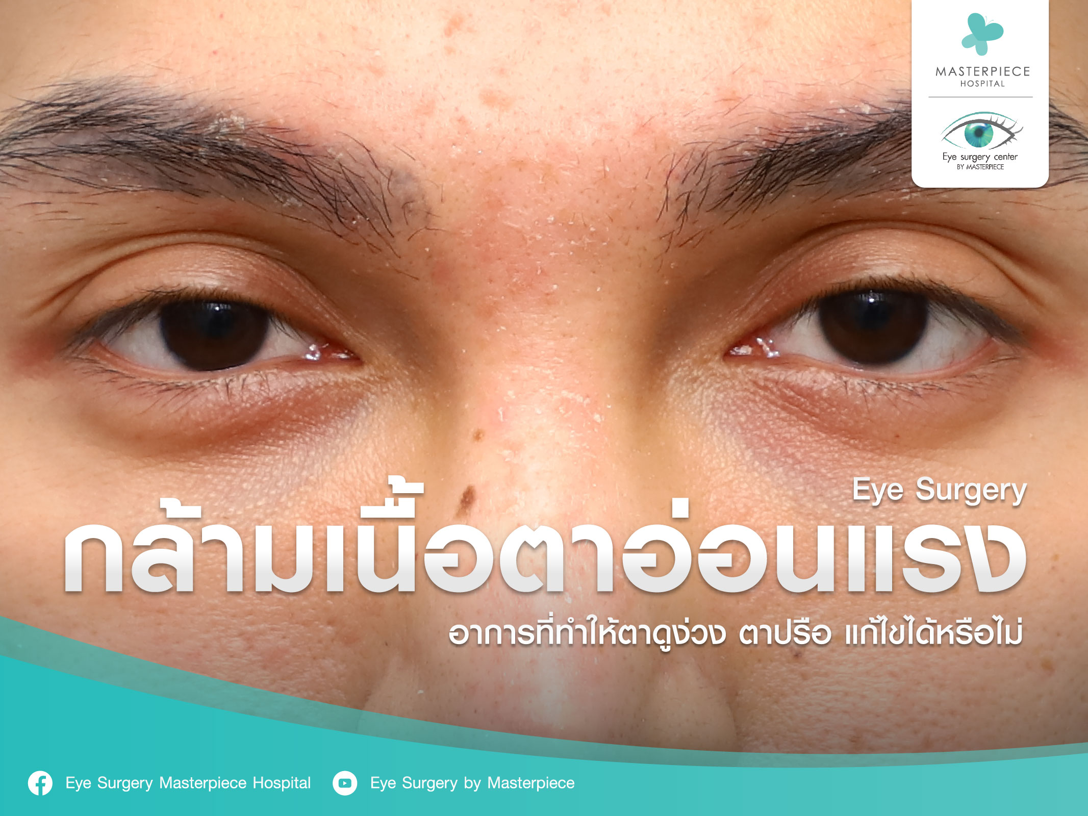 กล้ามเนื้อตาอ่อนแรง อาการที่ทำให้ตาดูง่วง ตาปรือ แก้ไขได้หรือไม่