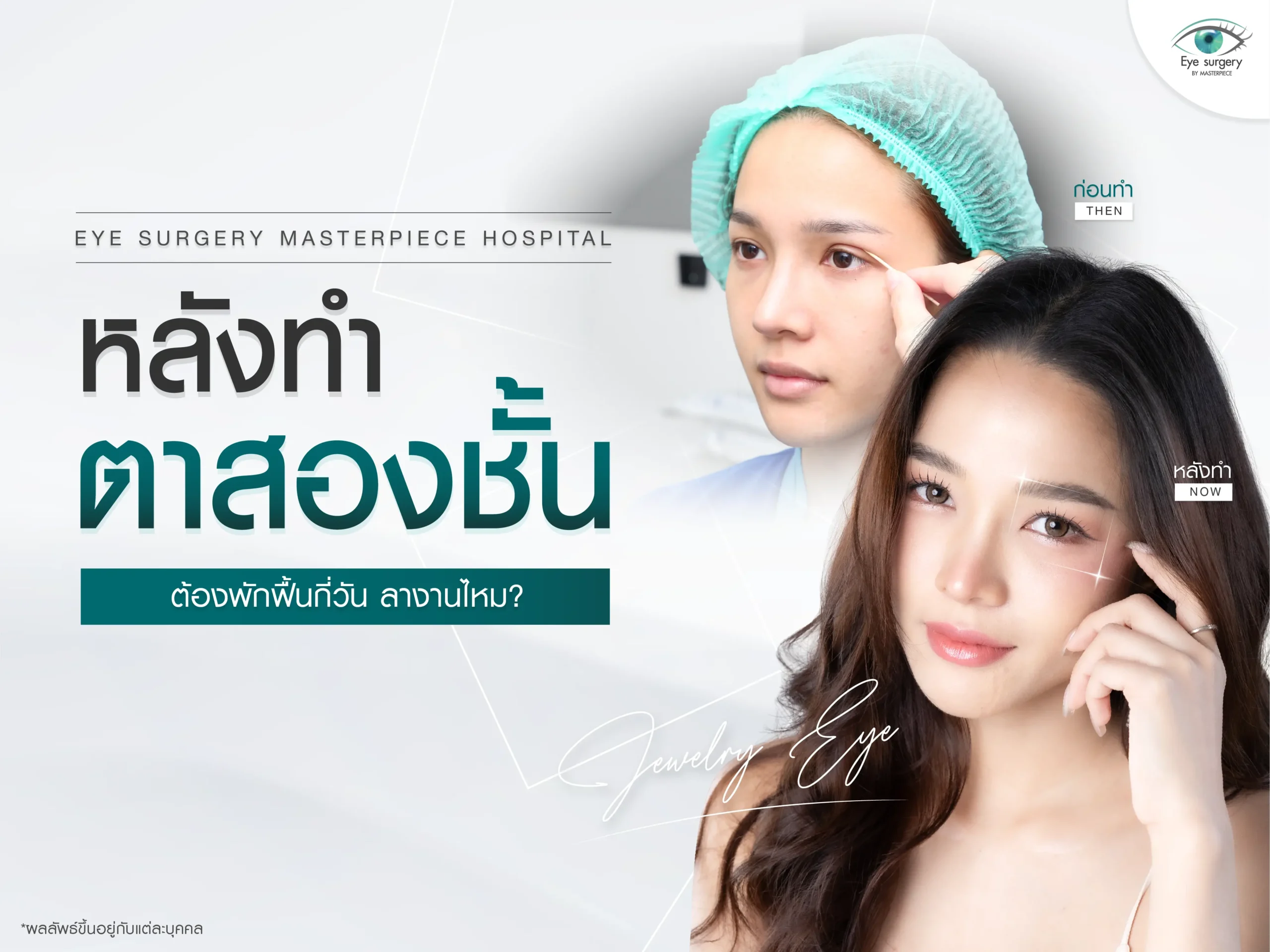 ทำตาสองชั้นพักฟื้นกี่วัน ต้องลางานไหม