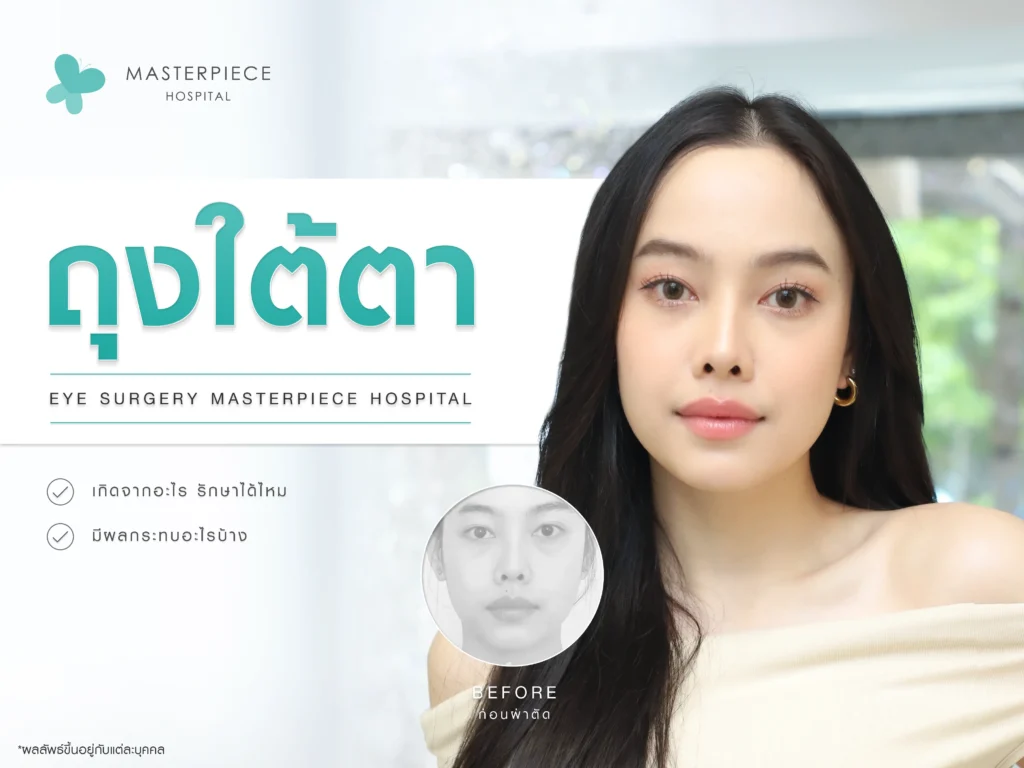 ถุงใต้ตาเกิดจากอะไร รักษาได้ไหม มีผลกระทบอะไรบ้าง