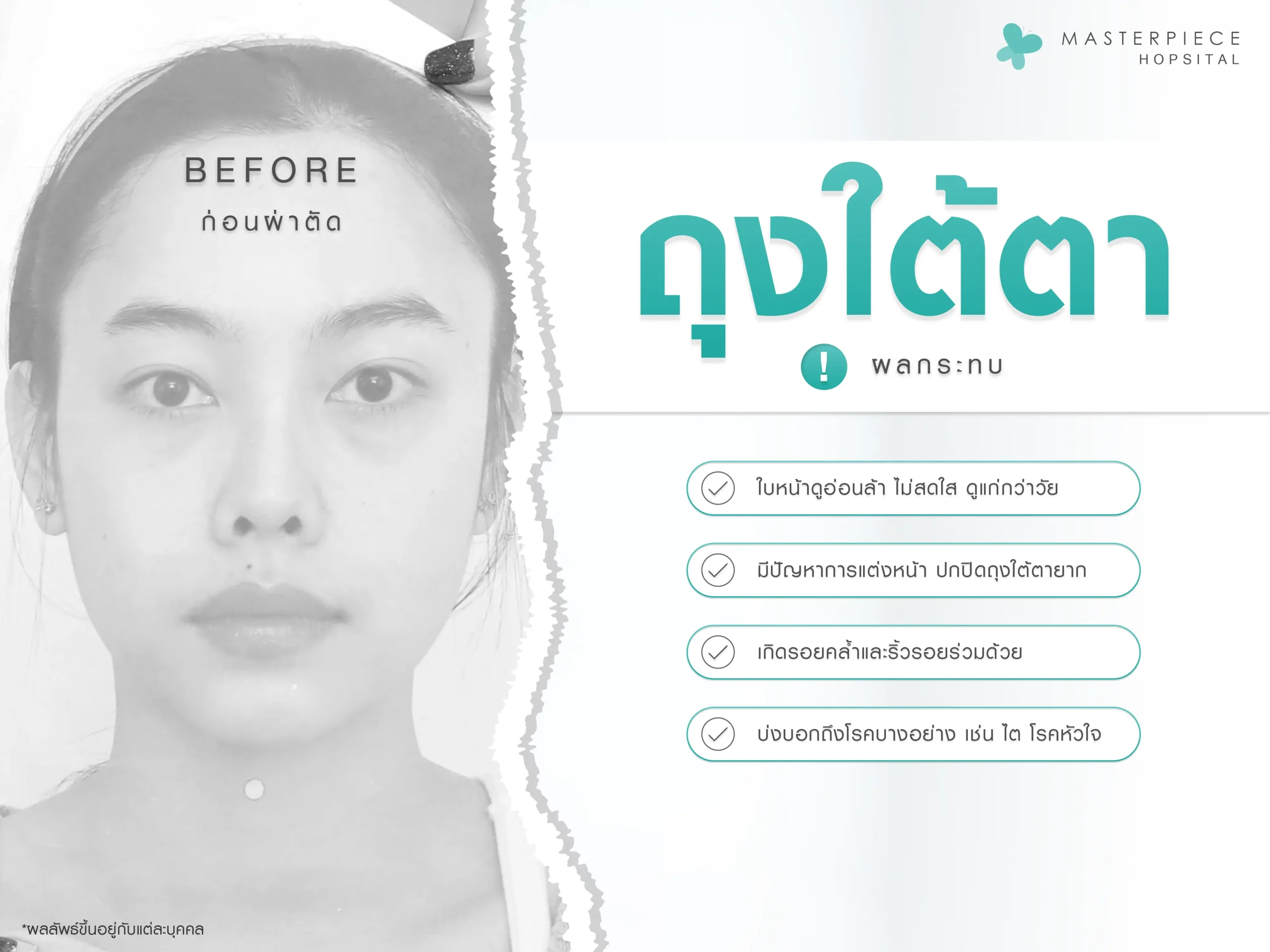 ผลกระทบของถุงใต้ตา