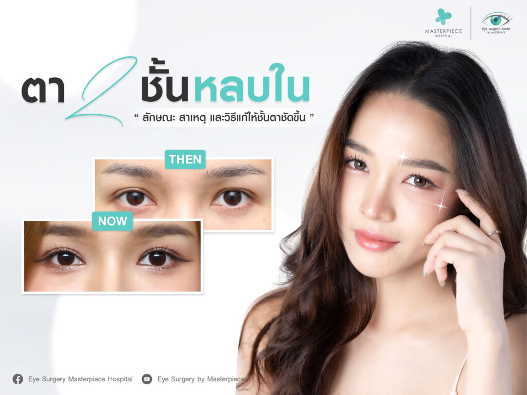 ตาสองชั้นหลบใน ลักษณะ สาเหตุ และวิธีแก้ให้ชั้นตาชัดขึ้น