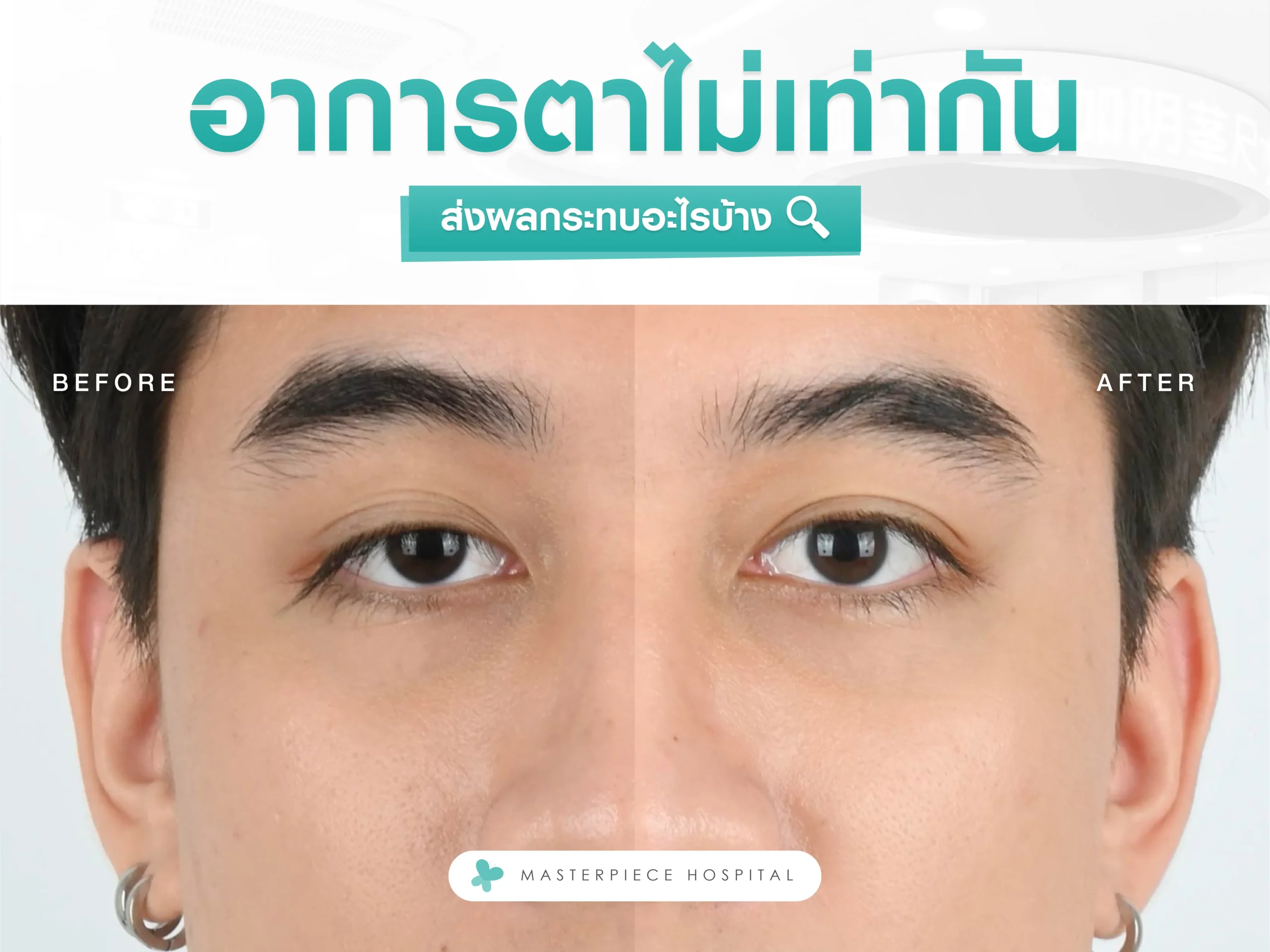 อาการตาไม่เท่ากันส่งผลกระทบอะไรบ้าง