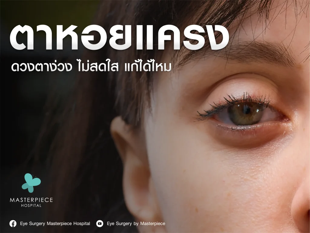 ตาหอยแครง เกิดจากอะไร ดวงตาที่ดูง่วงไม่สดใสสามารถแก้ได้ไหม